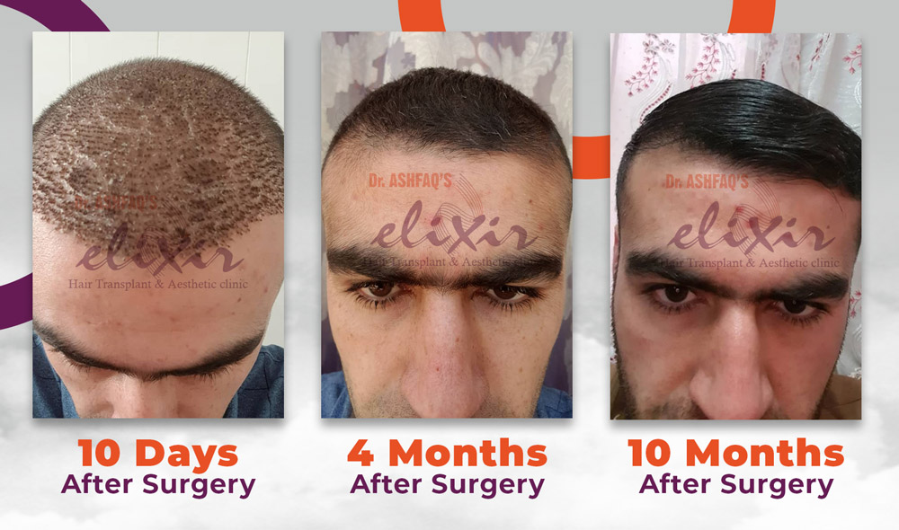 FUE Hair Transplant in Peshawar - Cost Effective Hair Loss Treatment