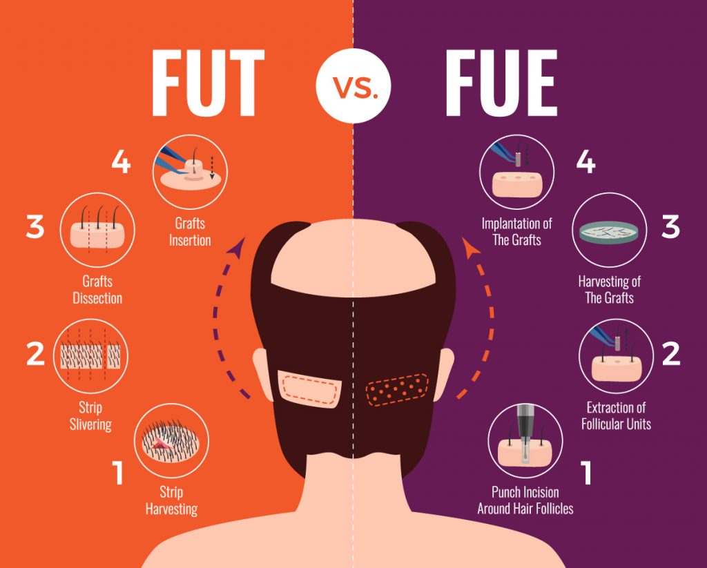 FUT vs FUE Hair Transplantation